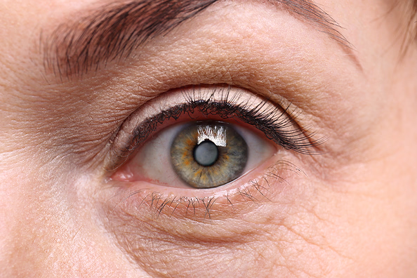 Cataracts